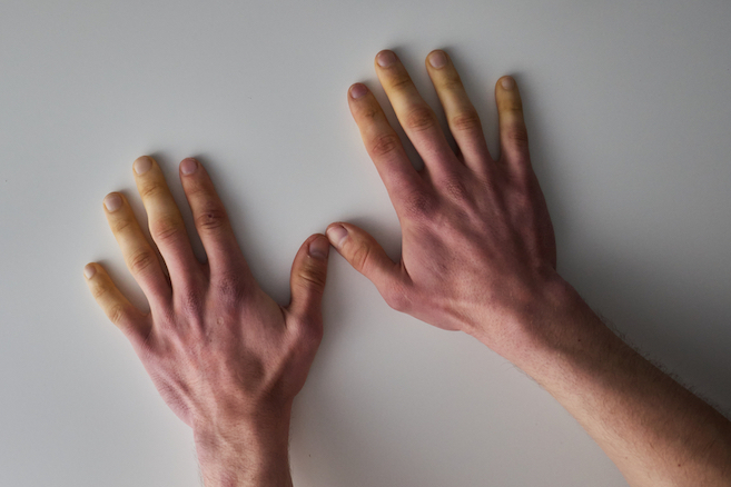 Hands with discolored fingers against a wall